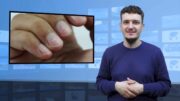 Białe plamy na paznokciach – trzeba do lekarza?